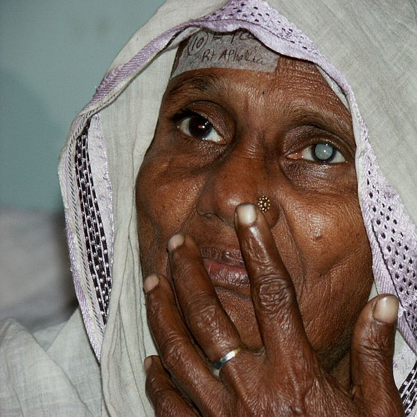Augenlicht retten: Der Graue Star ist in den meisten Fällen heilbar. Augenlicht retten: Eine alte Frau vor einer Augenoperation in Bangladesch am Grauen Star